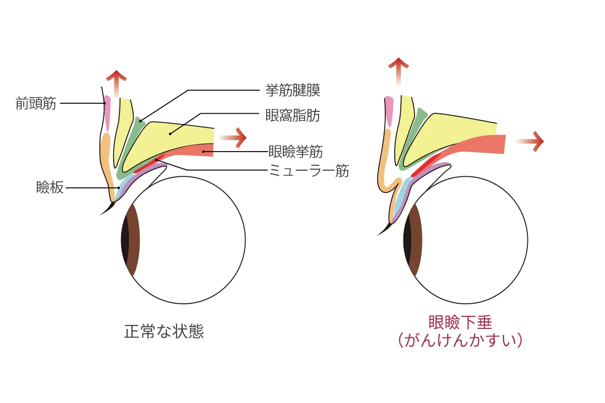 眼瞼下垂の原因