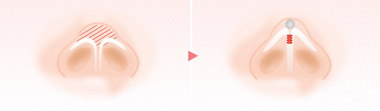 鼻尖先鋭術 鼻尖形成術 広島中央クリニック 公式