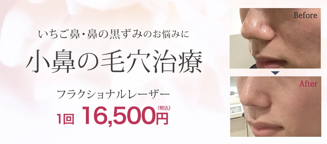 小鼻の毛穴治療