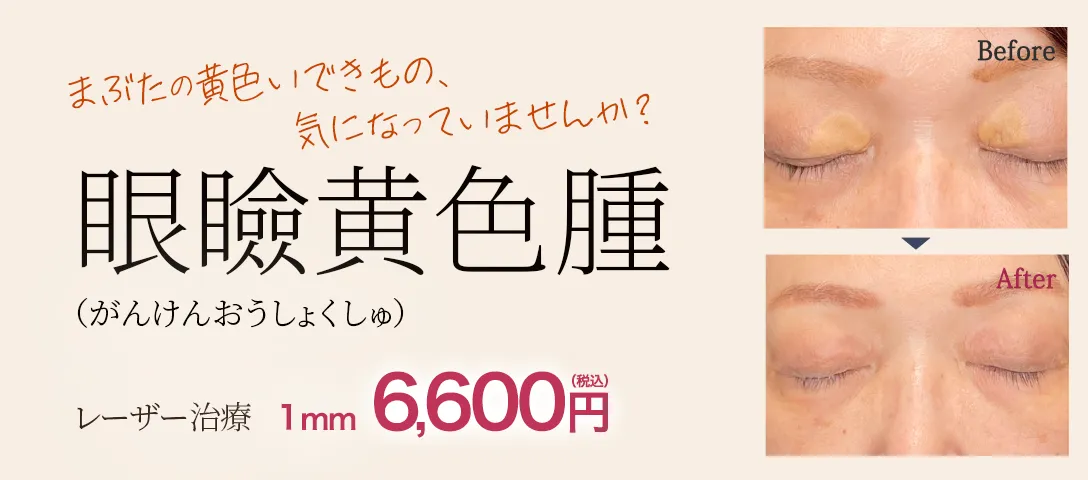 眼瞼黄色腫