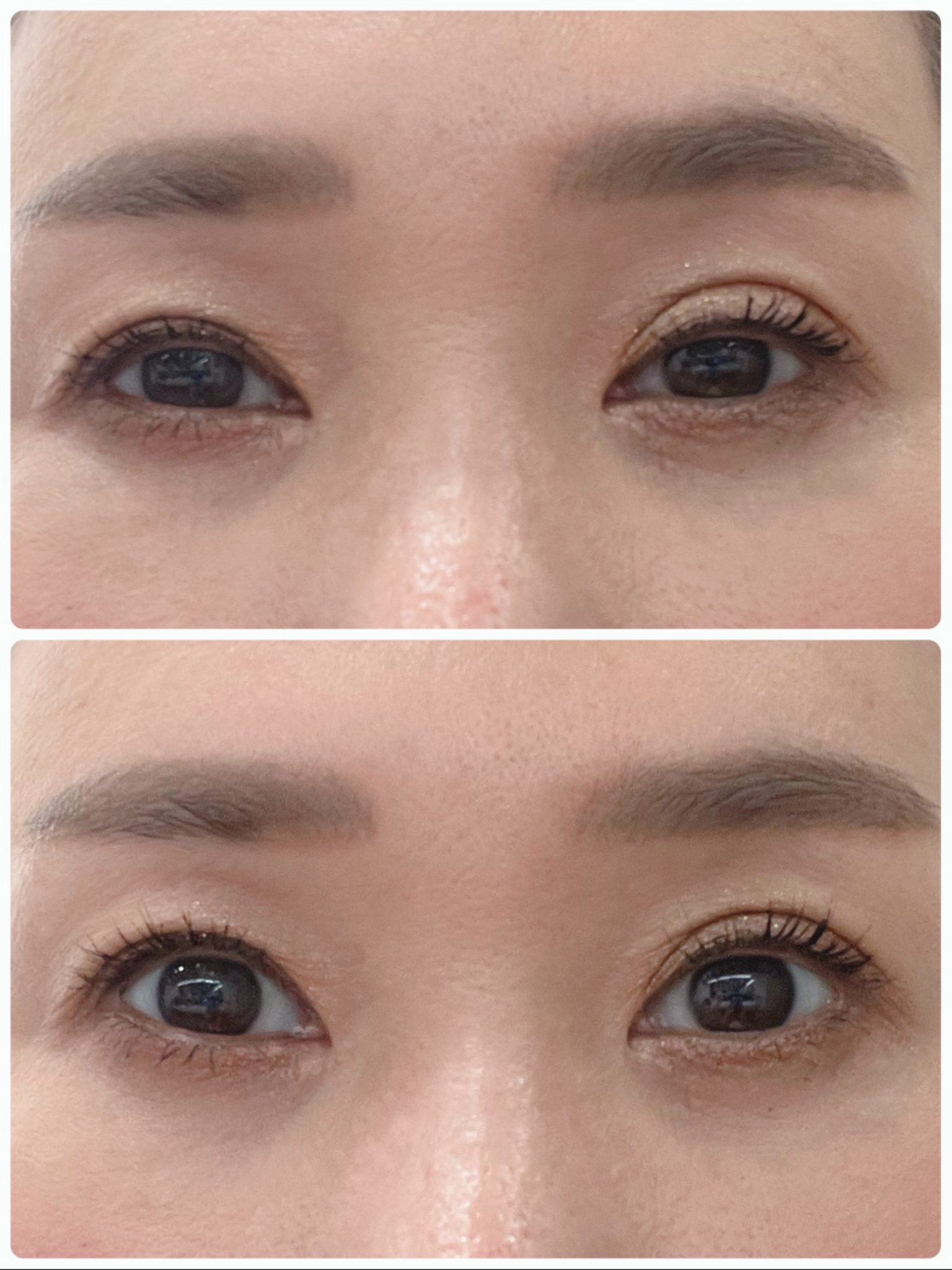 後天性眼瞼下垂治療薬「アップニークミニ点眼液」のお取り扱いがスタートしました | ラミュー広島中央クリニック【公式】
